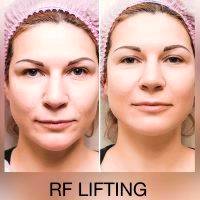 Radio Frequency Facelift Before And After Image