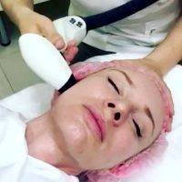 Radio Frequency Facelift Treatment Before And After (1)