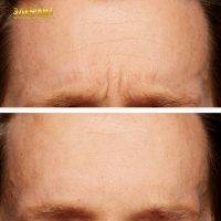 Radio Frequency Facelift Treatment Before And After (12)