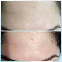 Radio Frequency Facelift Treatment Before And After (13)