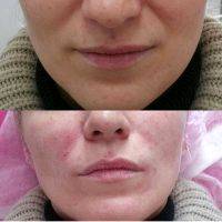 Radio Frequency Facelift Treatment Before And After (3)