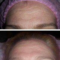 Radio Frequency Facelift Treatment Before And After (4)