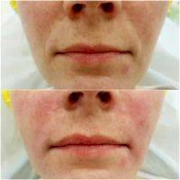 Radio Frequency Facelift Treatment Before And After (5)