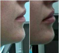 Radio Frequency Facelift Treatment Before And After (6)