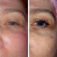 Radio Frequency Facelift Treatment Before And After (7)