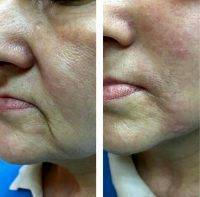 Radio Frequency Facelift Treatment Before And After (8)