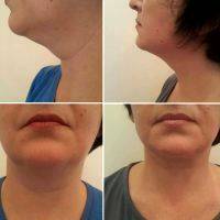 Radio Frequency Facelift Treatment Before And After (9)