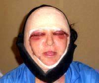 Recovery After Facelift In Medford Oregon