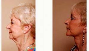 Refresher Lift - 71 Year Old Female With Dr Christian G. Drehsen, MD, Tampa Plastic Surgeon