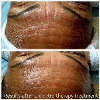 Results After 1 Electro Therapy Threatment