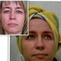 Rf Treatment For Face Before And After (4)