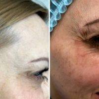 Rf Treatment For Face Before And After (6)