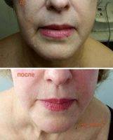 Rf Treatment For Face Before And After (8)