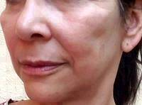 The Average Facelift Cost Is About $6,000