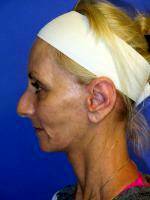 The New French Lift Tautens Sagging Skin With A Tiny Incision Behind The Ear