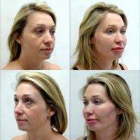 Thread Lift Facelift Before And After Photo