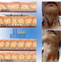 Ulthera Facelift Before And After Photo