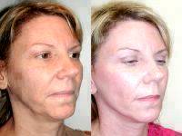 Weekend Facelift Before And After Photo