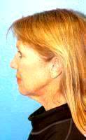 Weekend Facelift Is Generally More Common Than A Full Facelift