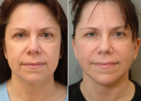 Weekend Facelift Pictures Before And After (1)