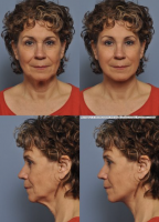 Weekend Facelift Pictures Before And After (2)