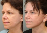 Weekend Facelift Pictures Before And After (3)