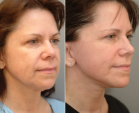 Weekend Facelift Pictures Before And After (5)