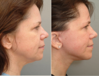 Weekend Facelift Pictures Before And After (6)