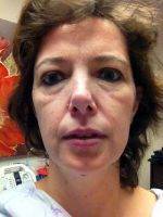Weekend Facelift Surgery Is The Most Common Type Of Facelift Surgery Performed Today