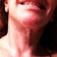 Weekend Lift Addresses The Jaw Line And The Lines From The Corners Of The Mouth To The Chin