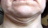 Wrinkles And Sagging Around The Lower Portion Of The Face