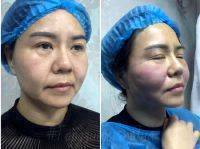 Y Lift Facelift Before And After