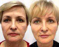 Y Lift Facelift Pictures Before And After