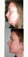 45-54 Year Old Woman Treated With Facelift By Doctor Keith Denkler, MD, Marin Plastic Surgeon