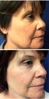 45-54 Year Old Woman Treated With Facelift By Dr Duane O. Hartshorn, MD, Grand Junction Facial Plastic Surgeon