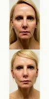 45-54 Year Old Woman Treated With Facelift With Doctor Ariel N. Rad, MD, PhD, Washington DC Plastic Surgeon