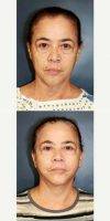 45-54 Year Old Woman Treated With Facelift With Dr. Jose M. Soler-Baillo, MD, Miami Plastic Surgeon