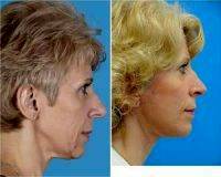 50 Yo Female With Sagging Neck And Nose Hump By Dr. Jose E. Barrera, MD, FACS, San Antonio Facial Plastic Surgeon