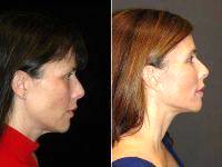 51 Year Old Female By Doctor Goesel Anson, MD, FACS, Las Vegas Plastic Surgeon