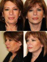 53 Year Old Female With Dr. Timothy Treece, MD, FACS, Columbus Plastic Surgeon
