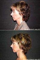 54 Year-old Female With Complaints Of Jowls And Neck Laxity (looseness) With Dr Milind K. Ambe, MD, Orange County Plastic Surgeon