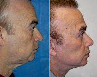 55-64 Year Old Man Treated With Facelift By Dr Elliot M. Heller, MD, New York Facial Plastic Surgeon