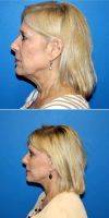 55-64 Year Old Man Treated With Facelift With Dr Ed Breazeale, Jr., MD, Knoxville Plastic Surgeon