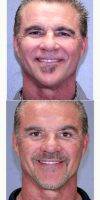 55-64 Year Old Man Treated With Facelift With Dr. John A. Standefer Jr., MD, FACS, Dallas Facial Plastic Surgeon