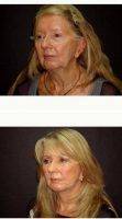 55-64 Year Old Woman Treated With Facelift By Doctor Dominic Castellano, MD, Tampa Facial Plastic Surgeon