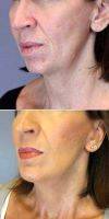 55-64 Year Old Woman Treated With Facelift By Doctor Elizabeth Whitaker, MD, FACS, Atlanta Facial Plastic Surgeon