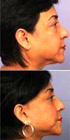 55-64 Year Old Woman Treated With Facelift By Doctor Grant Stevens, MD, Los Angeles Plastic Surgeon