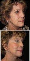 55-64 Year Old Woman Treated With Facelift By Doctor Jeffrey Umansky, MD, La Jolla Plastic Surgeon