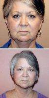 55-64 Year Old Woman Treated With Facelift By Dr Fara Movagharnia, DO, FACOS, Atlanta Plastic Surgeon