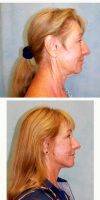 55-64 Year Old Woman Treated With Facelift By Dr Gregory C. Gaines, MD, Gainesville Plastic Surgeon